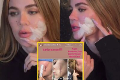 Khloe Kardashian shares frightening photos of ‘crazy’ plastic surgery stitches on her face